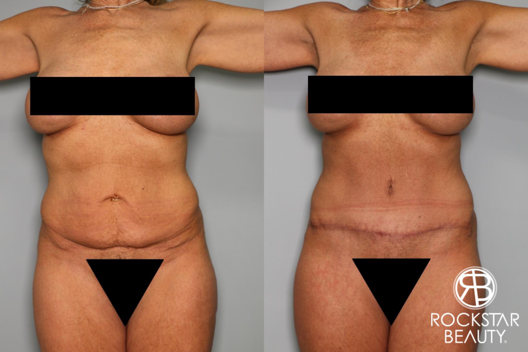 Tummy Tuck: Patient 6 - Before and After  