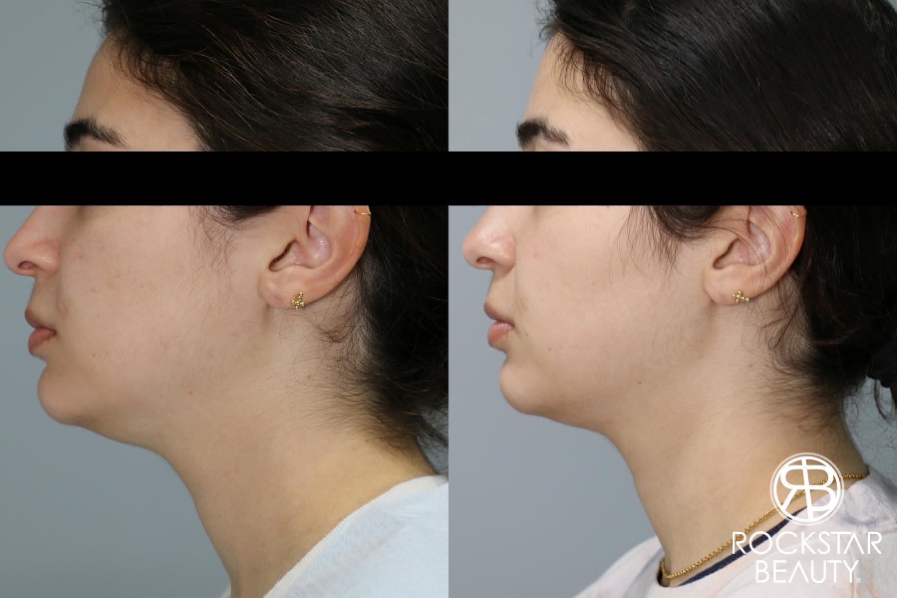 Liposuction Of The Neck: Patient 50 - Before and After 1