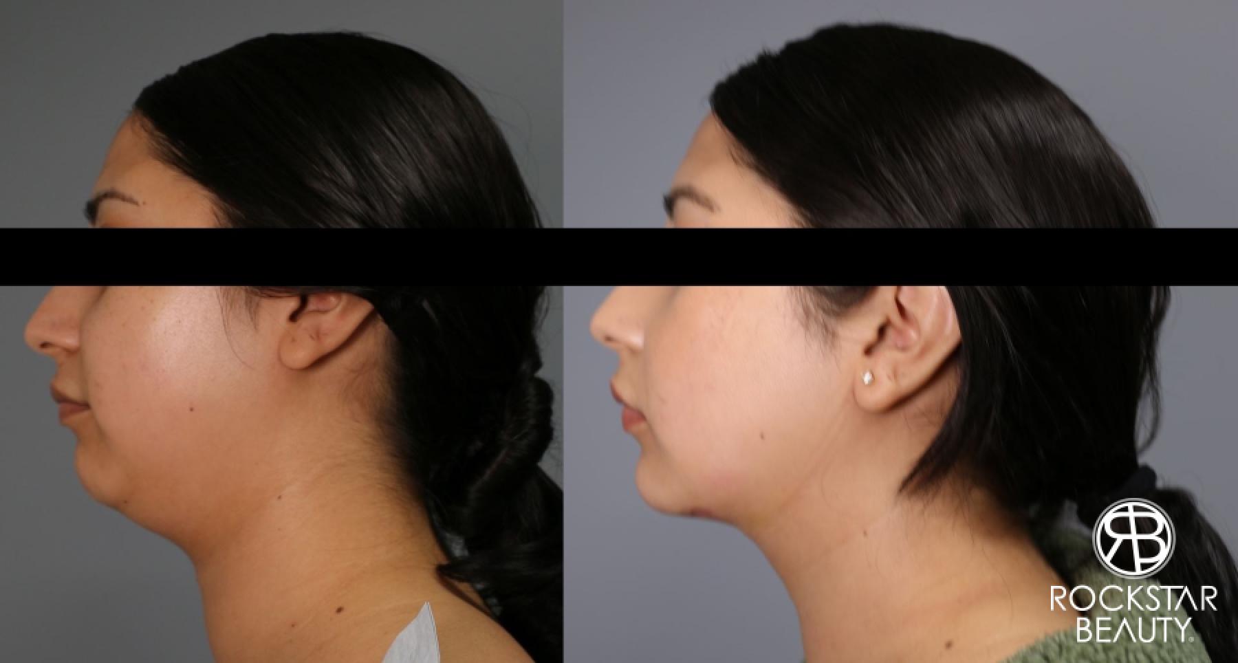 Liposuction Of The Neck: Patient 21 - Before and After 1