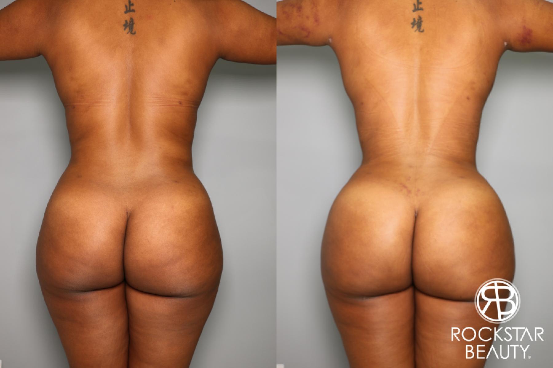 Brazilian Butt Lift: Patient 5 - Before and After  