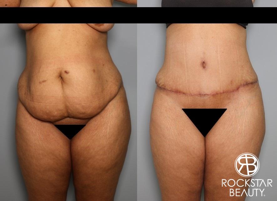 Tummy Tuck: Patient 4 - Before and After  