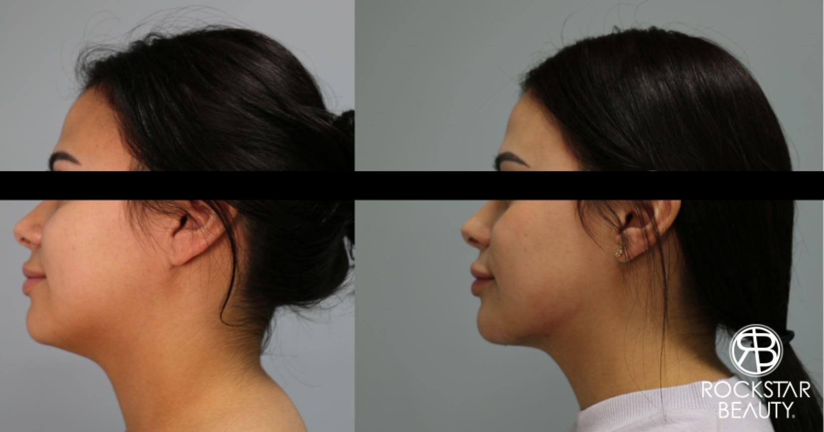 Liposuction Of The Neck: Patient 27 - Before and After 1