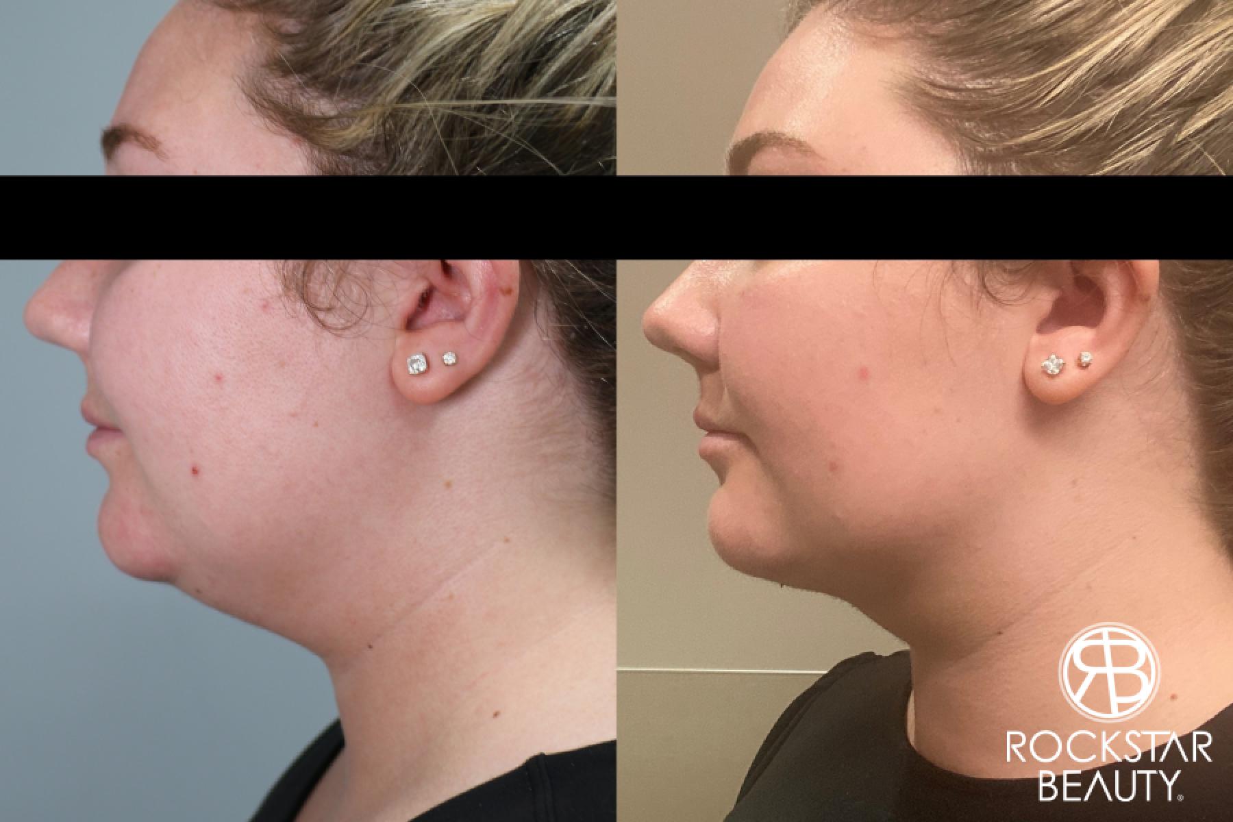 Liposuction Of The Neck: Patient 48 - Before and After 1