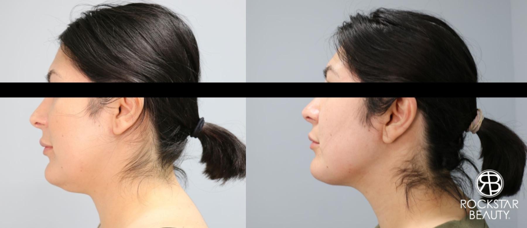 Liposuction Of The Neck: Patient 25 - Before and After 1