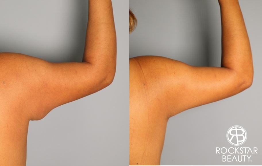 Liposuction: Patient 10 - Before and After  