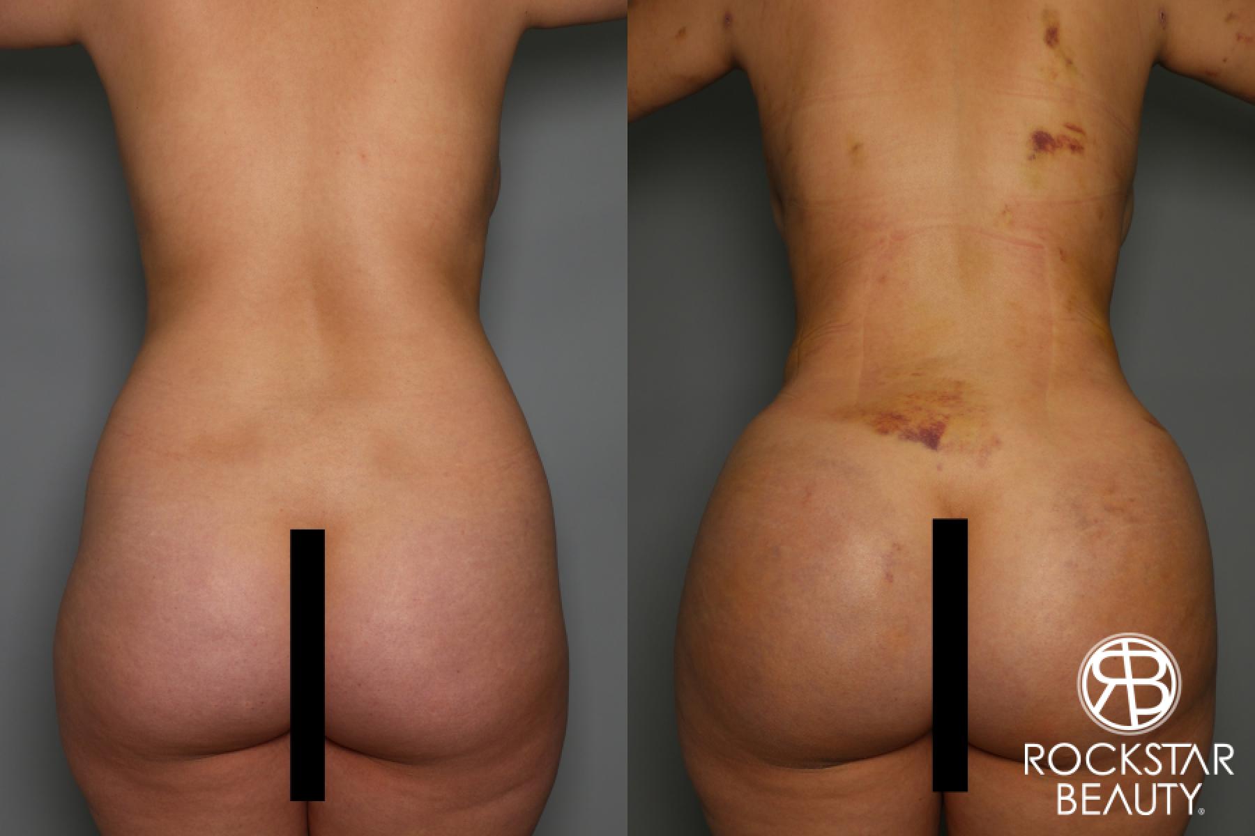 Brazilian Butt Lift: Patient 13 - Before and After 1