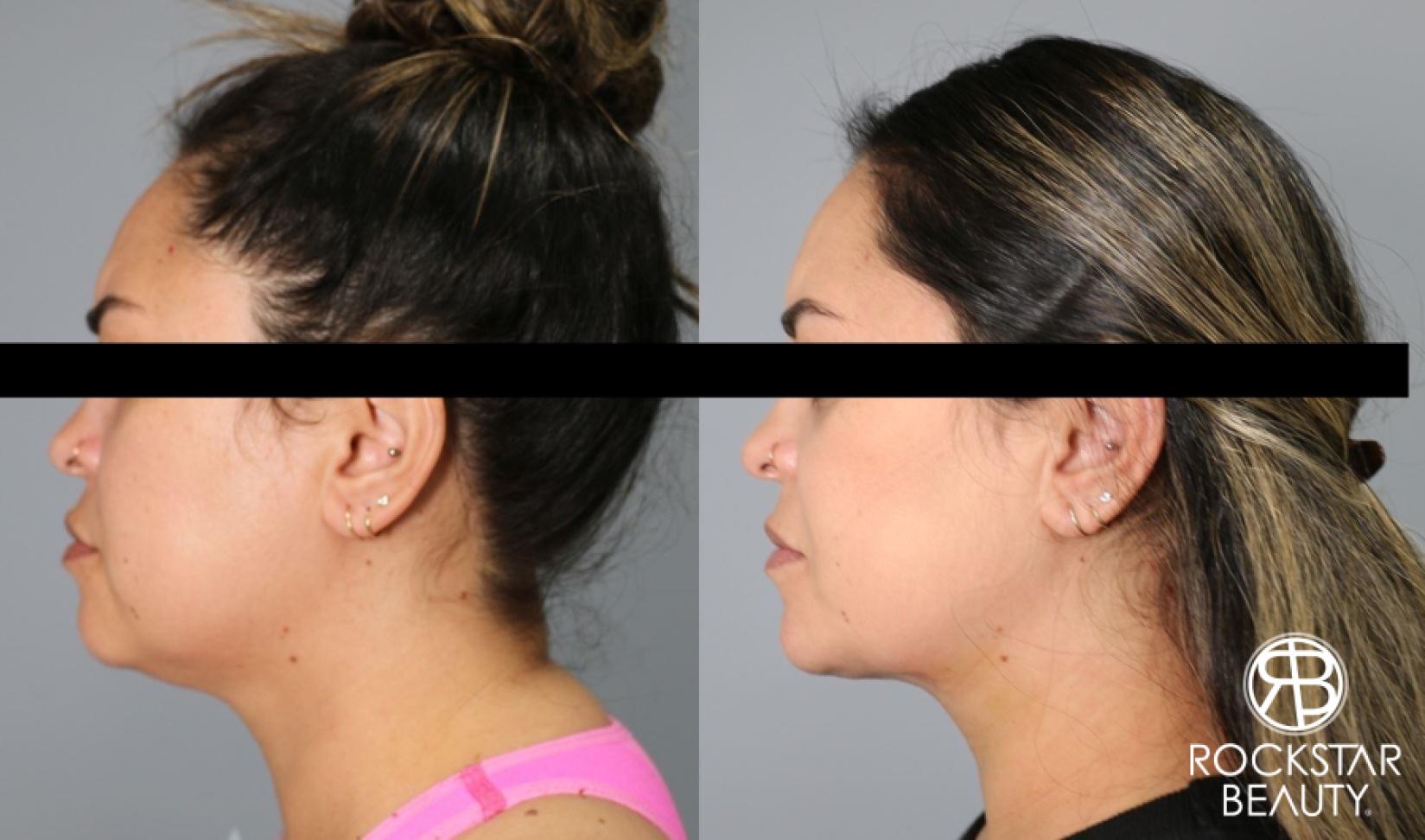 Liposuction Of The Neck: Patient 18 - Before and After 1