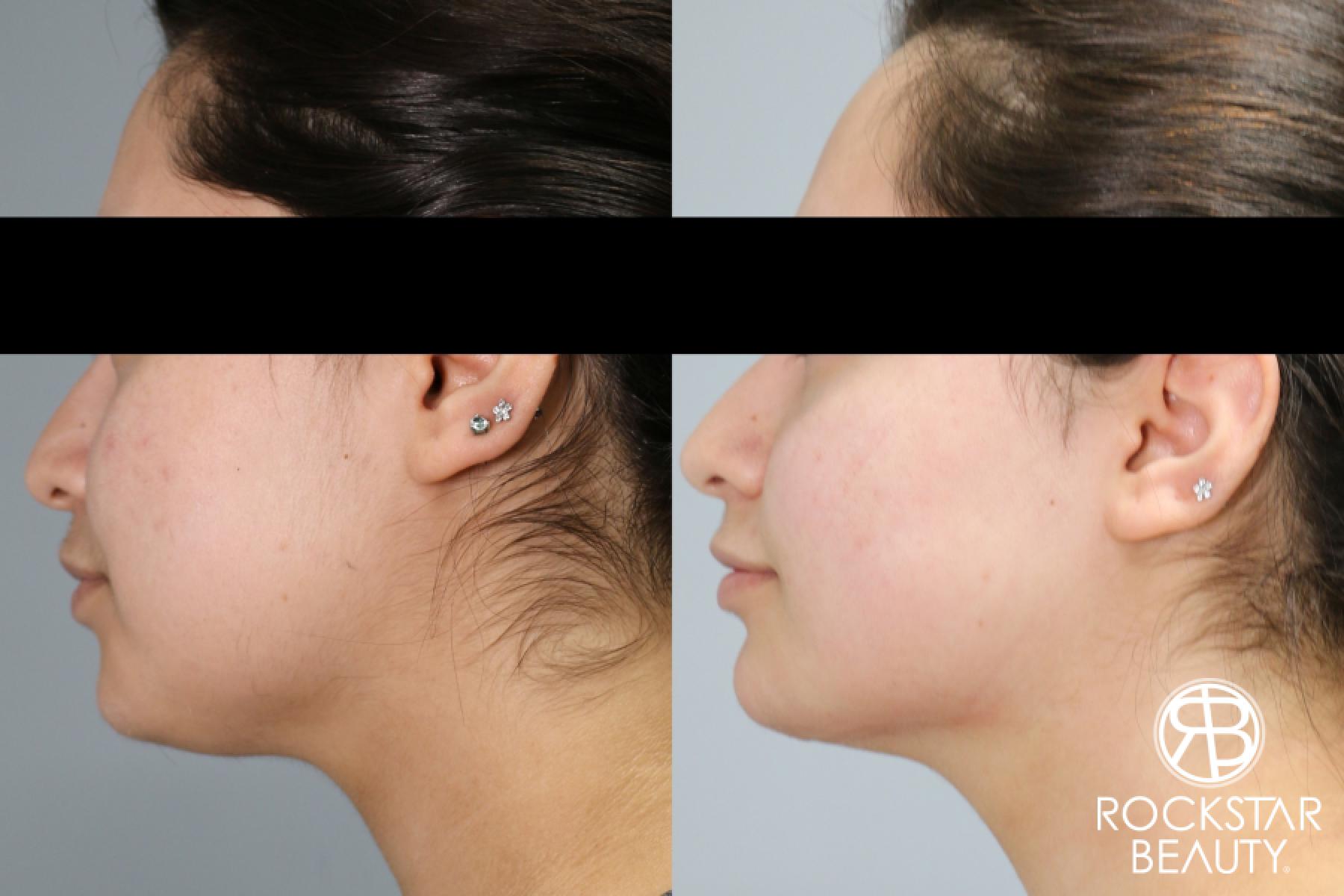 Liposuction Of The Neck: Patient 68 - Before and After 1