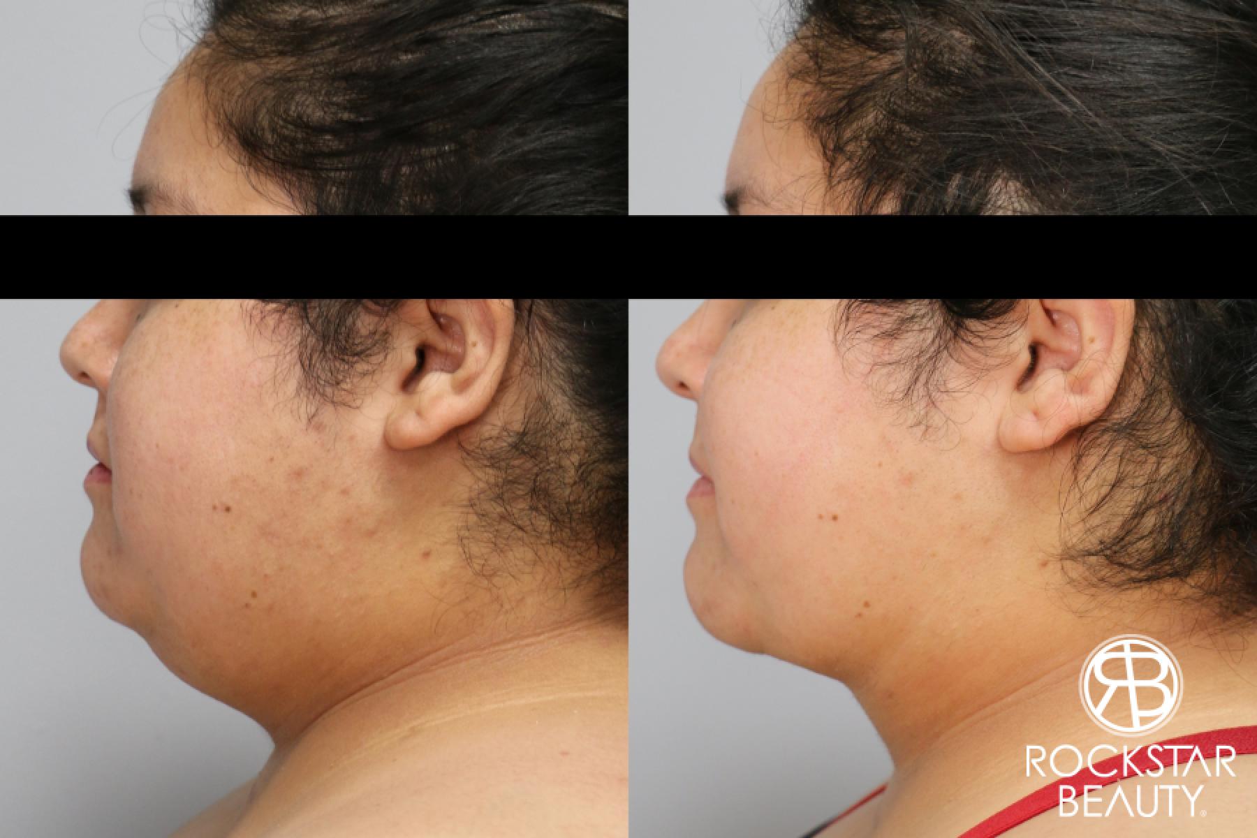 Liposuction Of The Neck: Patient 69 - Before and After 1