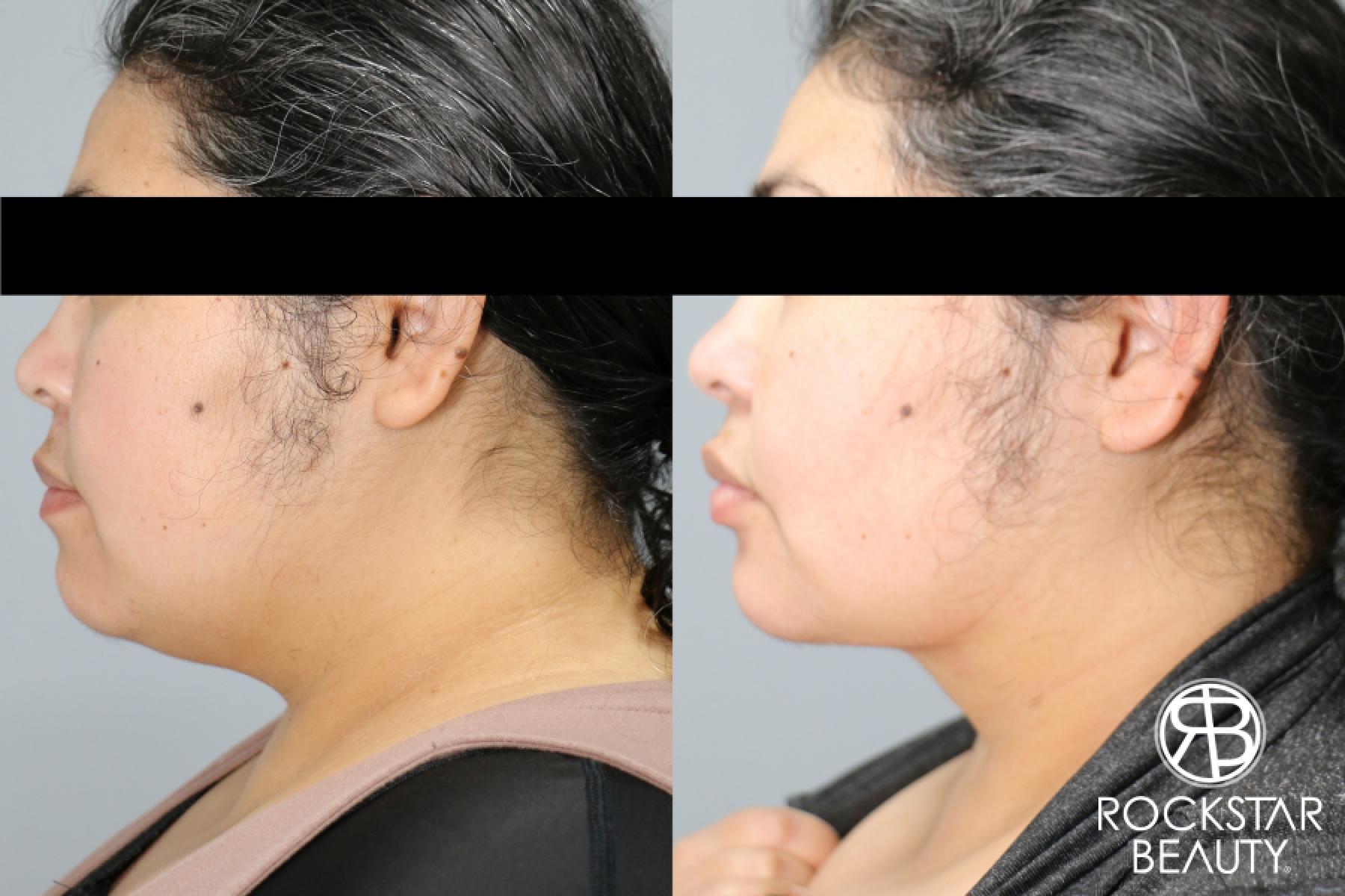 Liposuction Of The Neck: Patient 65 - Before and After 1