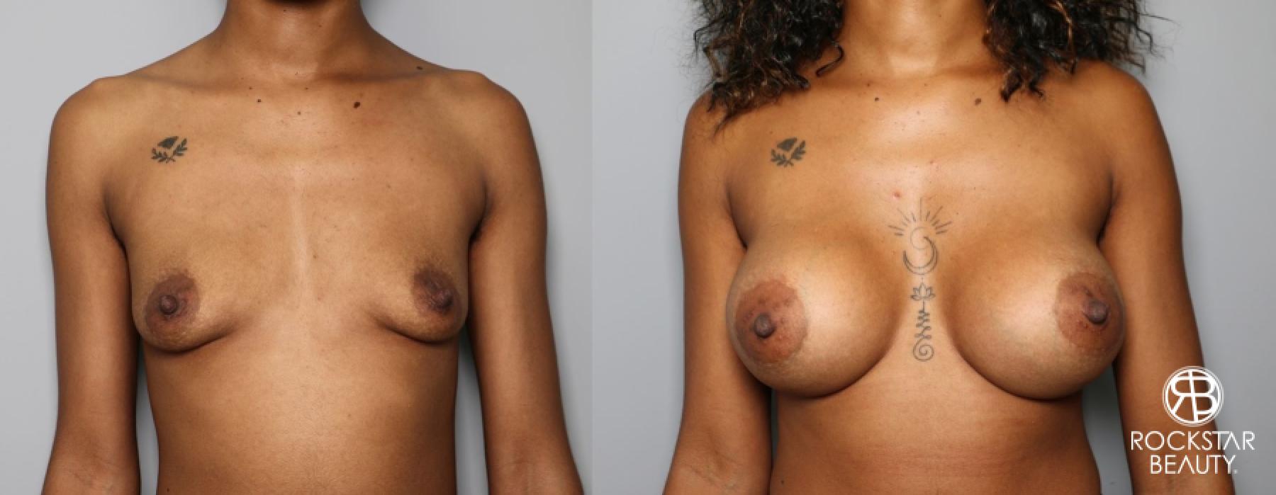 Breast Augmentation: Patient 13 - Before and After 1