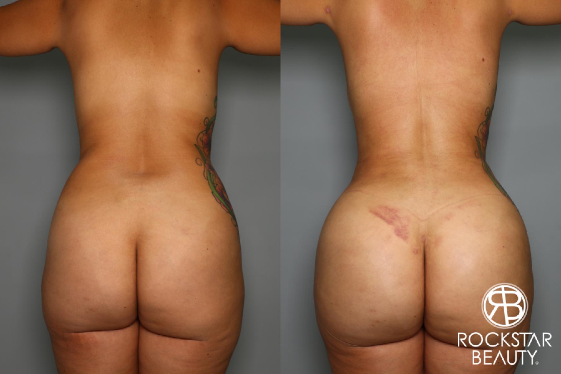 Brazilian Butt Lift: Patient 7 - Before and After  