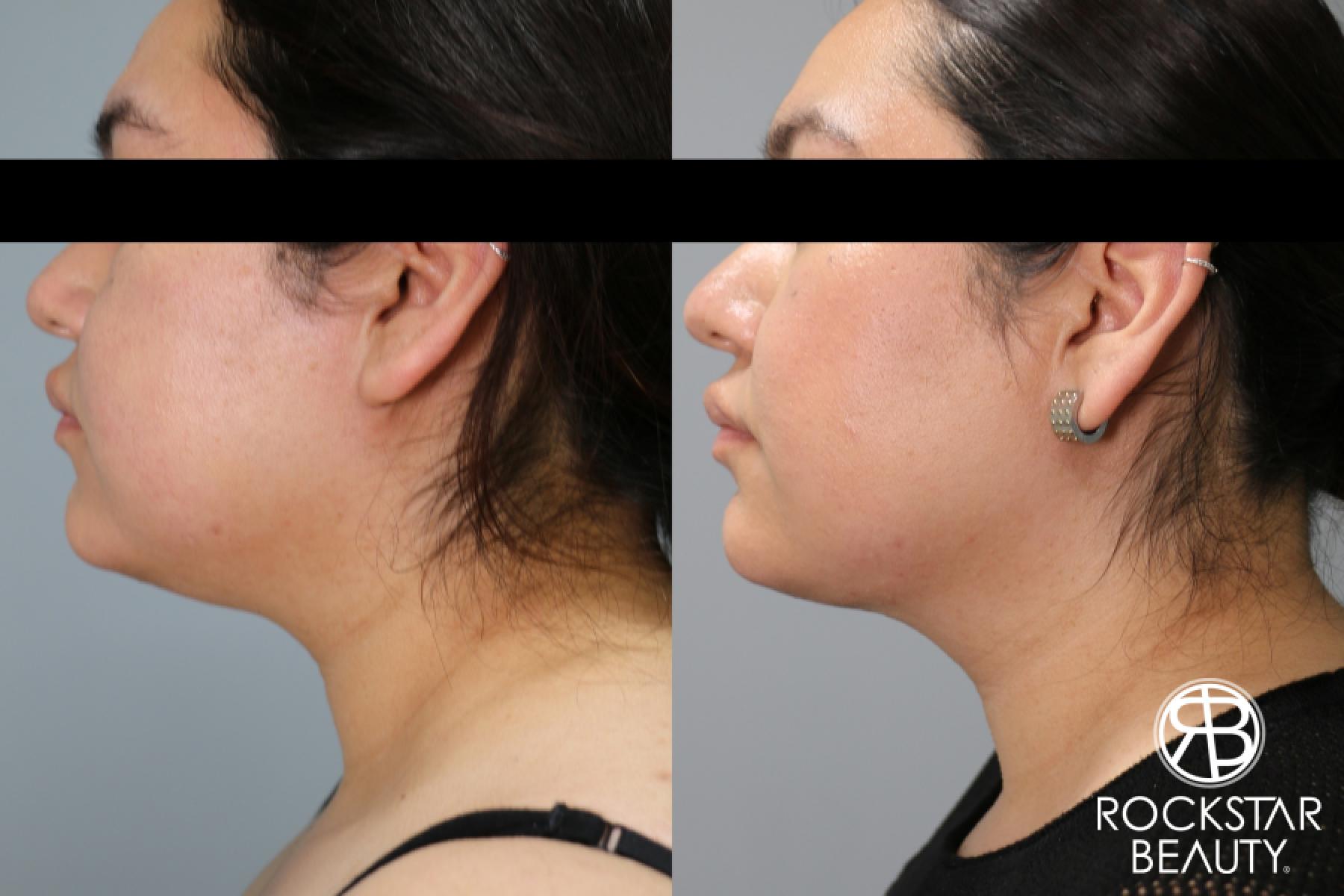 Liposuction Of The Neck: Patient 62 - Before and After 1