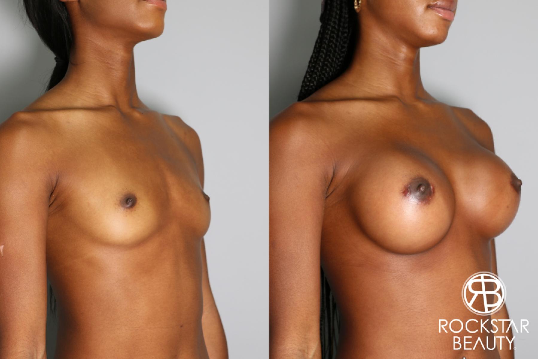 Breast Augmentation: Patient 26 - Before and After 2