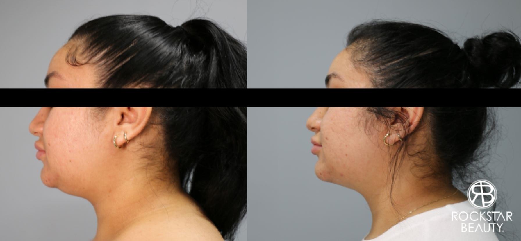 Liposuction Of The Neck: Patient 73 - Before and After 1