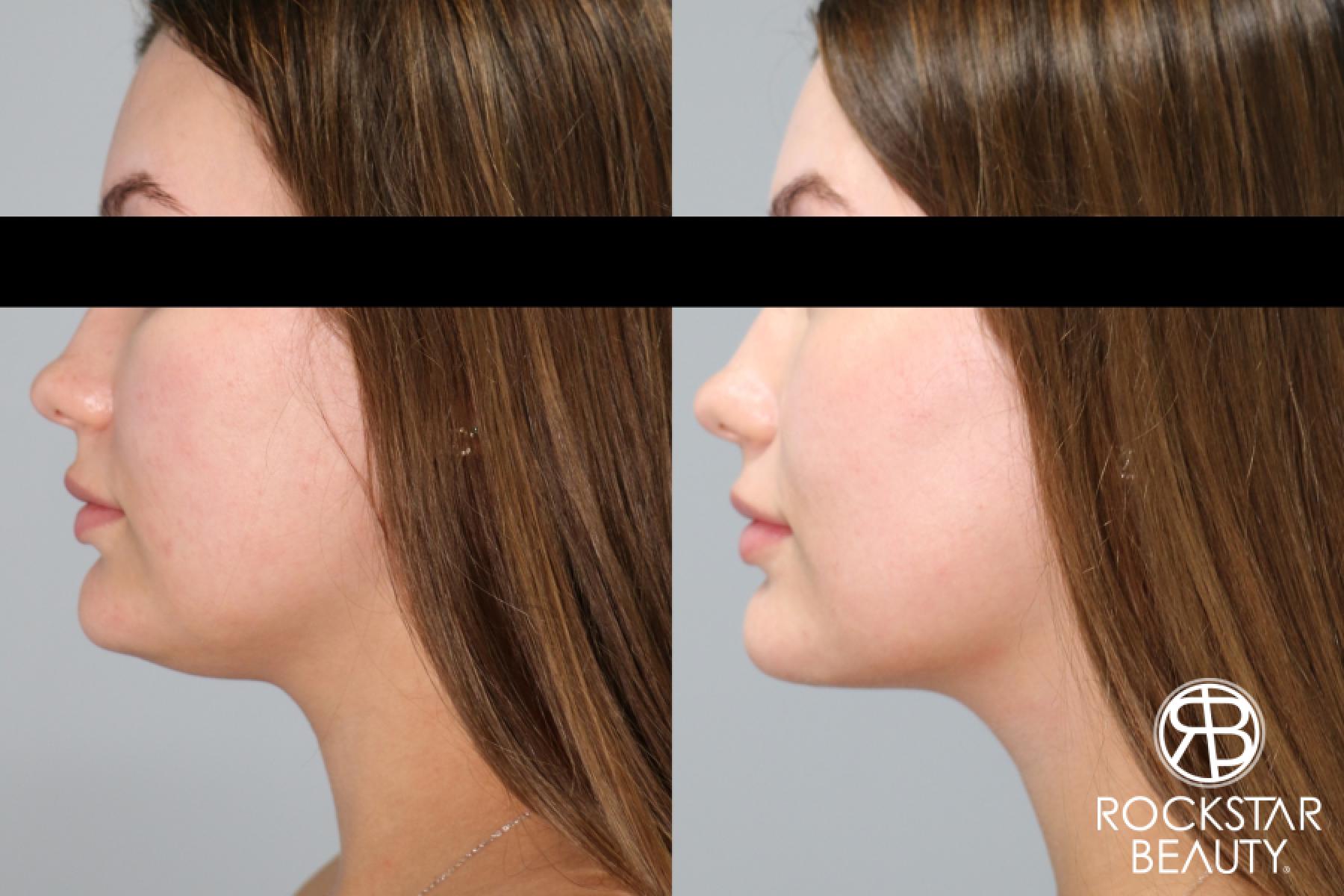 Liposuction Of The Neck: Patient 70 - Before and After 1