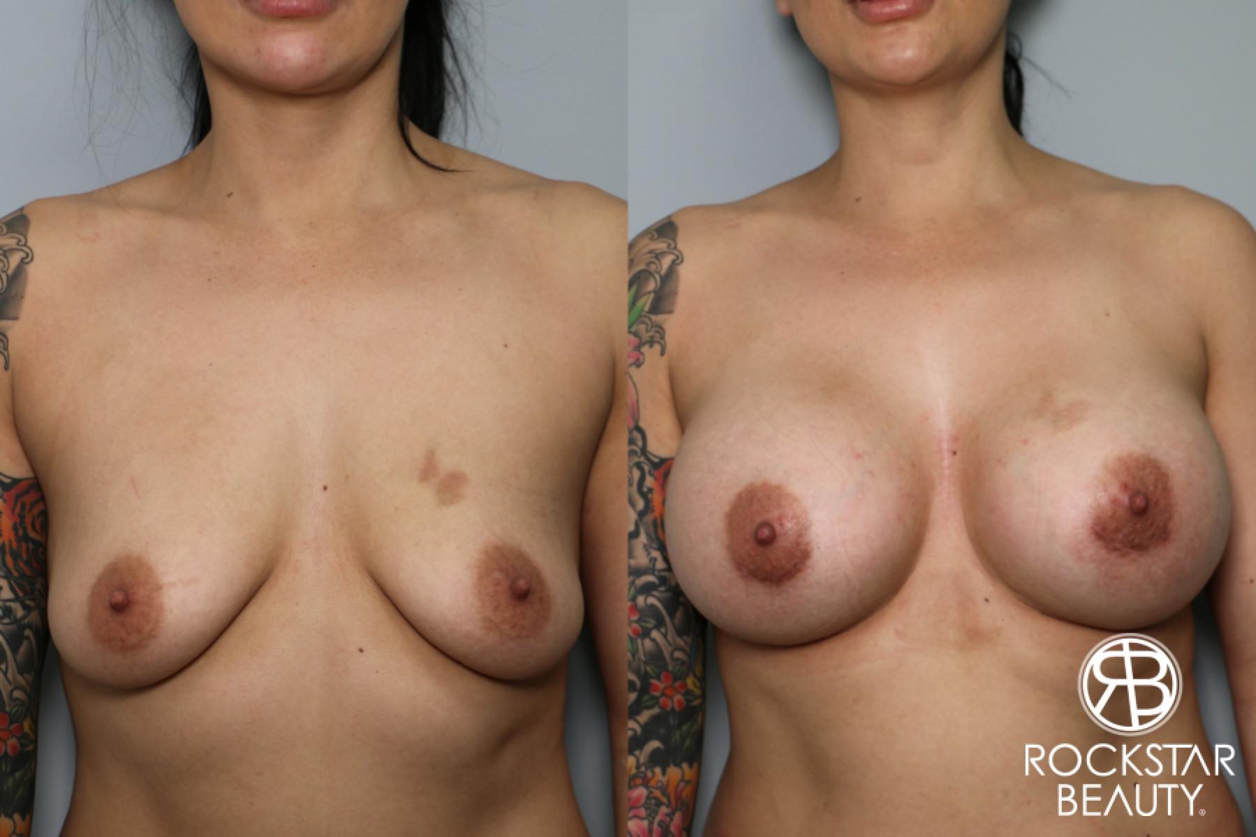 Breast Augmentation: Patient 23 - Before and After 1