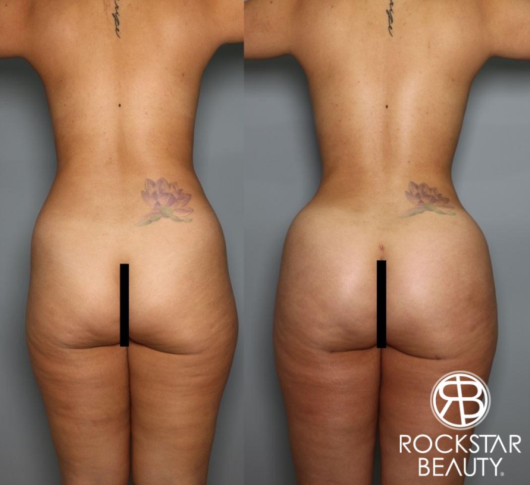 Brazilian Butt Lift: Patient 11 - Before and After 1