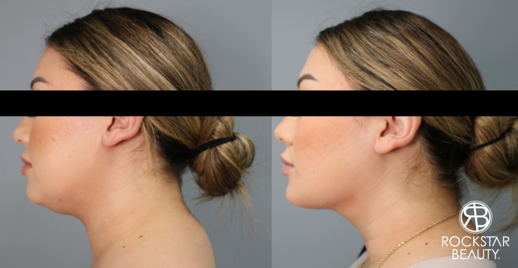 Liposuction Of The Neck: Patient 1 - Before and After 1