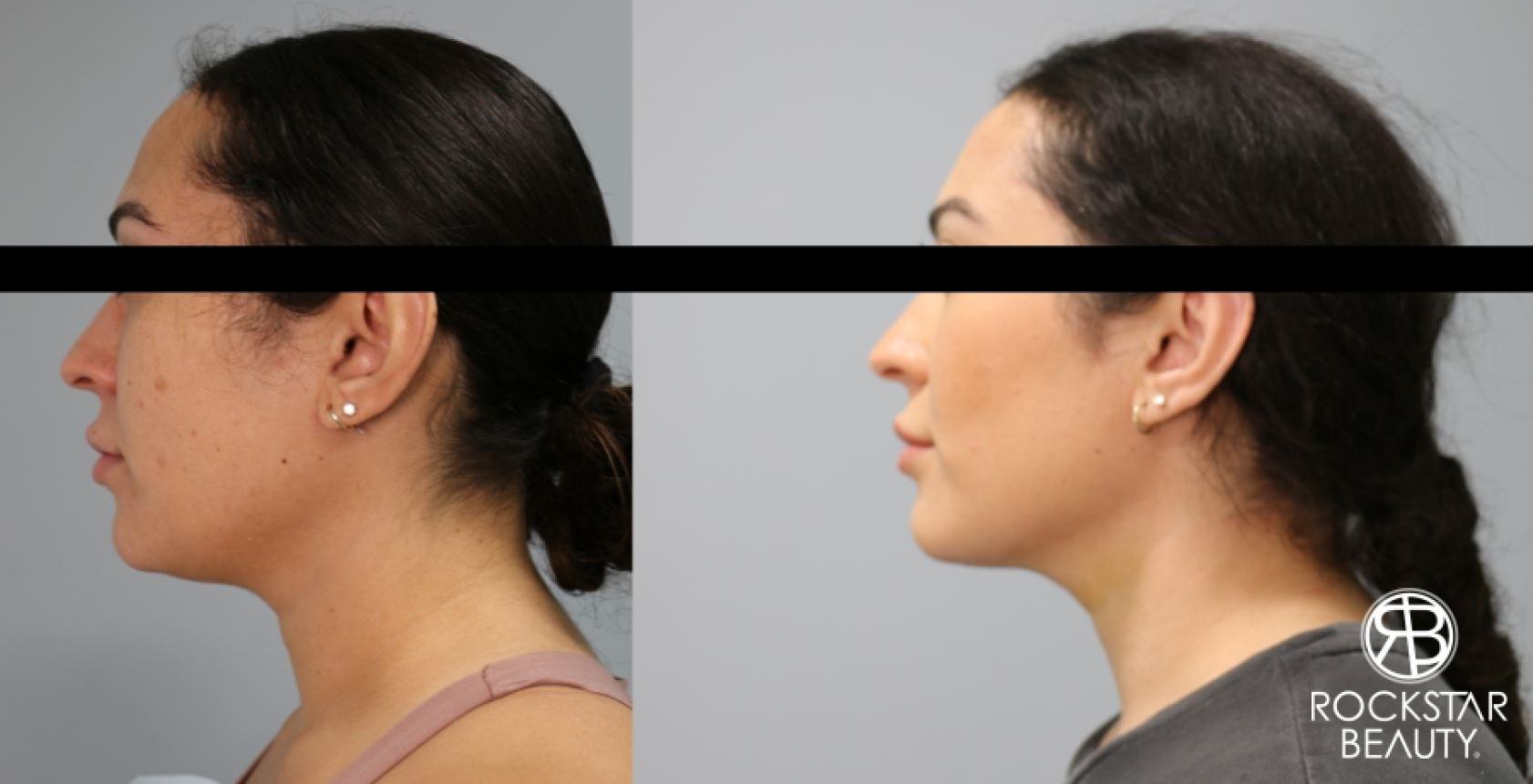 Liposuction Of The Neck: Patient 82 - Before and After 1