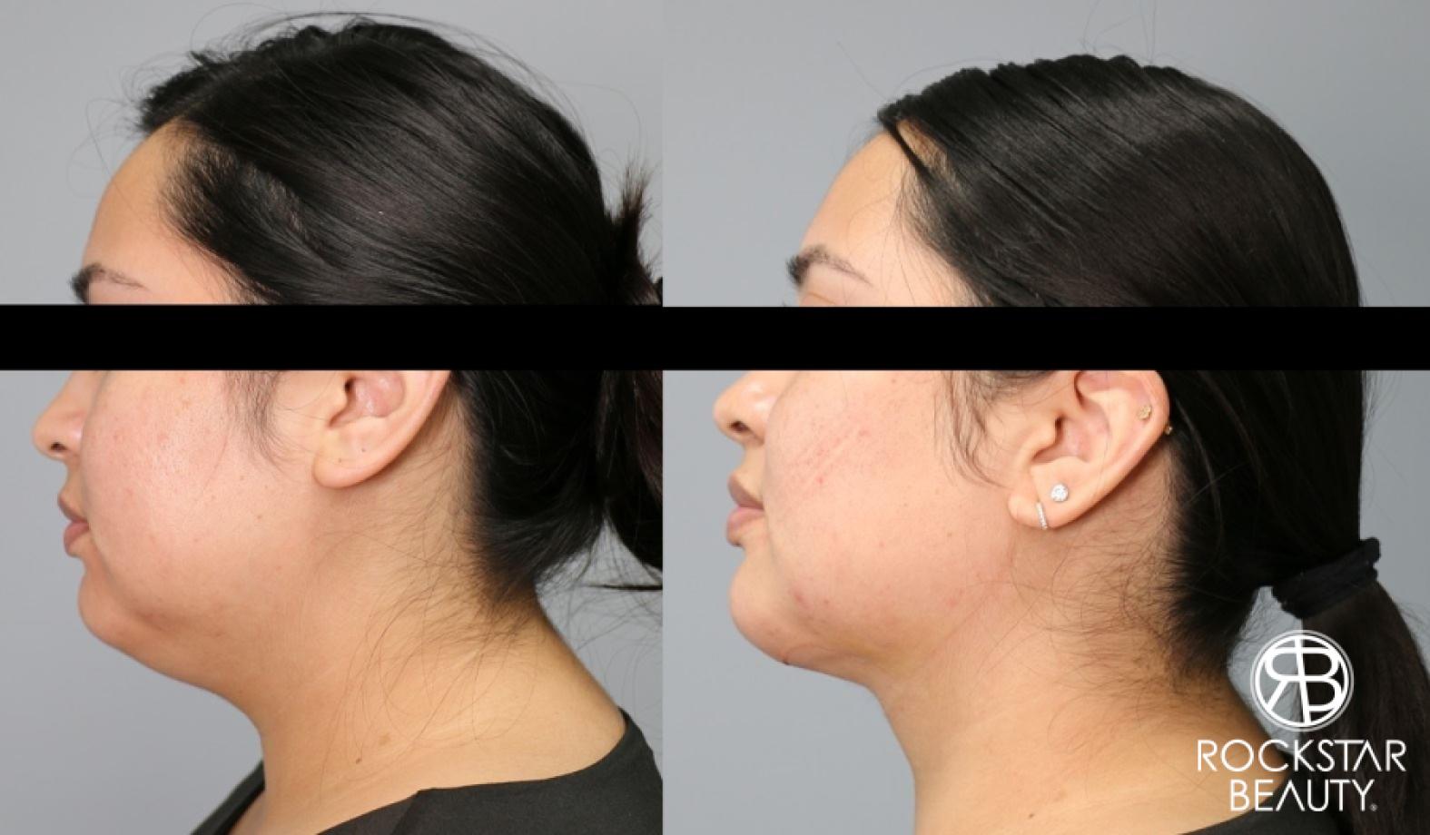 Liposuction Of The Neck: Patient 20 - Before and After 1