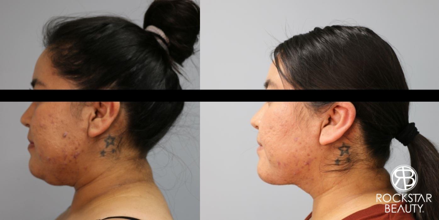 Liposuction Of The Neck: Patient 16 - Before and After 1