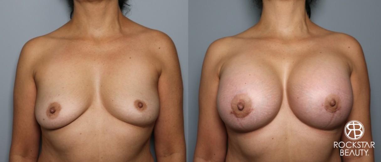 Breast Augmentation: Patient 12 - Before and After 1