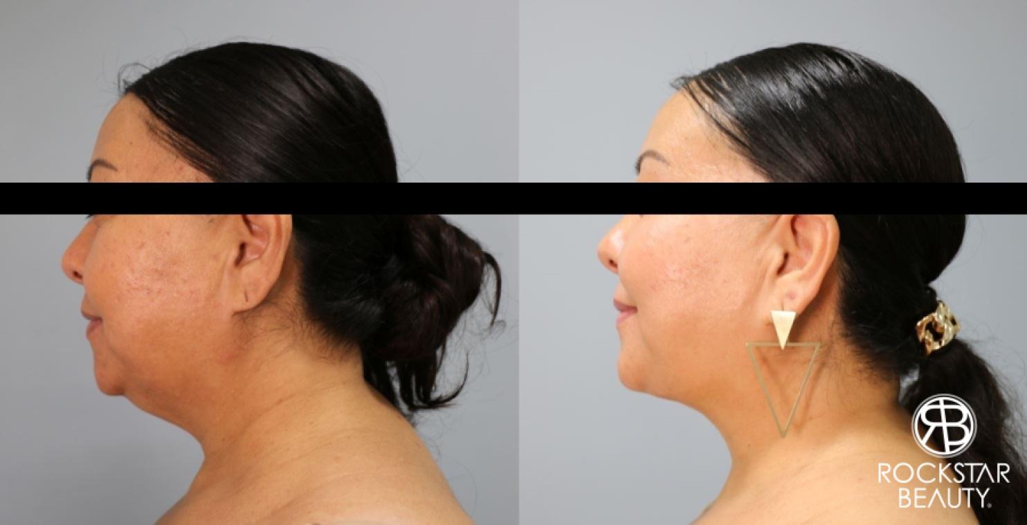 Liposuction Of The Neck: Patient 55 - Before and After 1