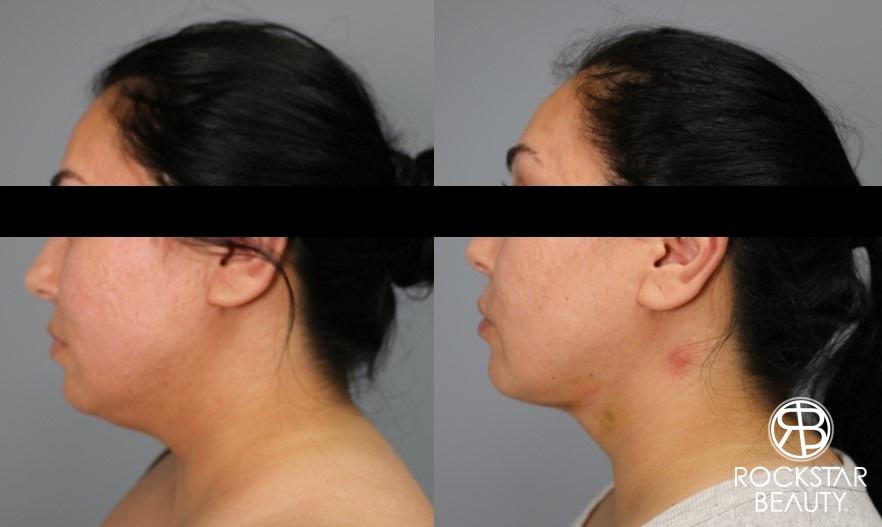 Liposuction Of The Neck: Patient 35 - Before and After 1