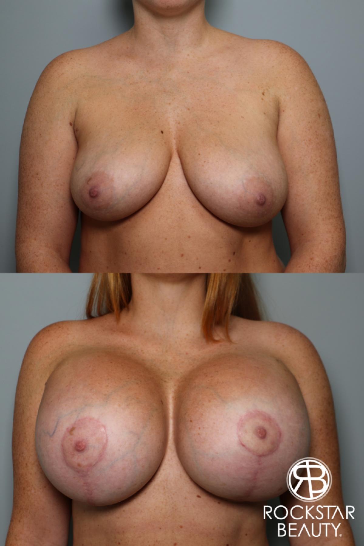 Breast Augmentation With Lift: Patient 2 - Before and After  