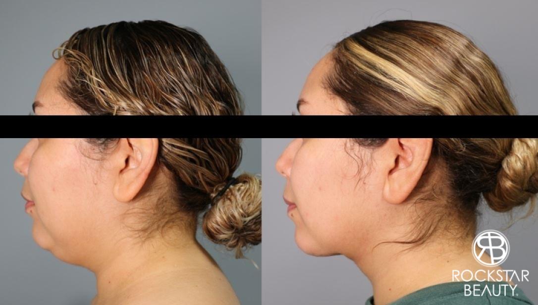 Liposuction Of The Neck: Patient 29 - Before and After 1