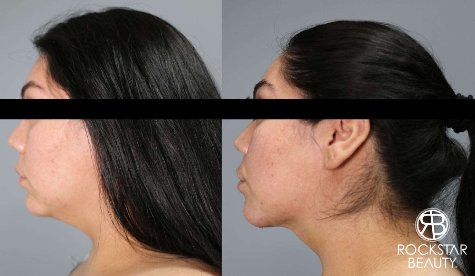 Liposuction Of The Neck: Patient 33 - Before and After 1