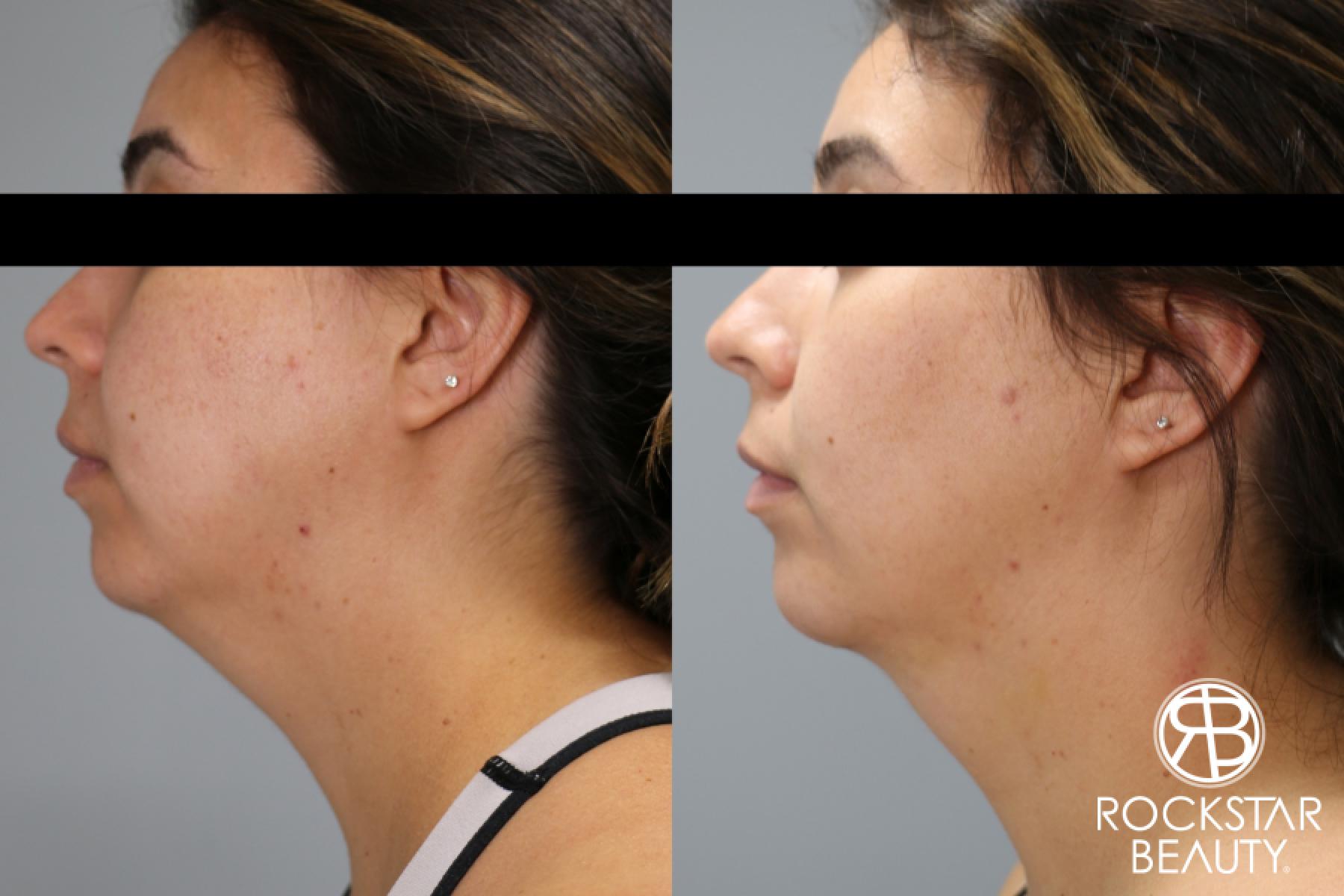 Liposuction Of The Neck: Patient 76 - Before and After 1