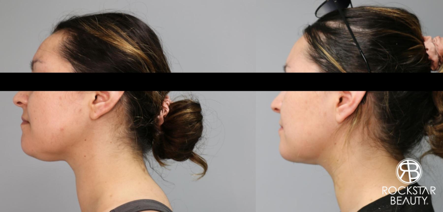 Liposuction Of The Neck: Patient 49 - Before and After 1