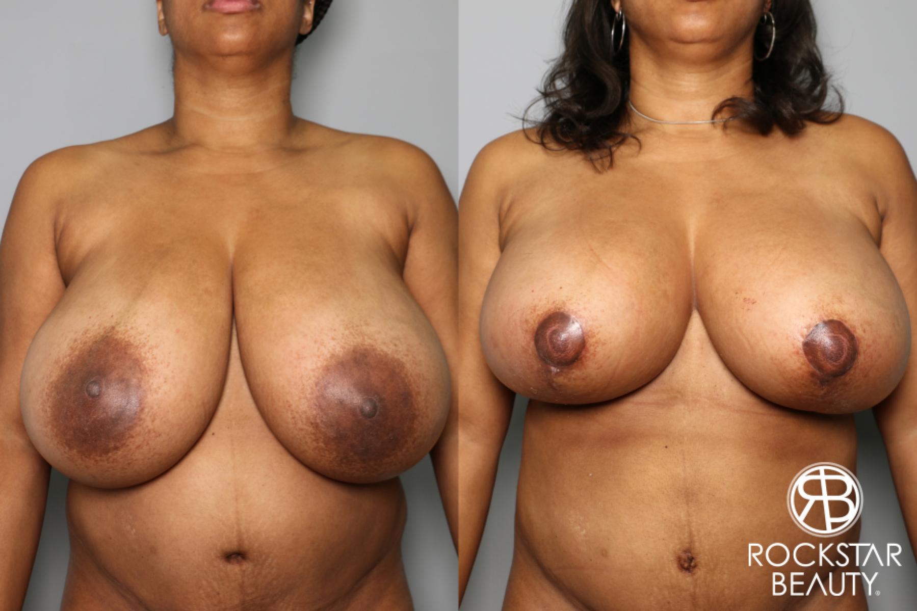 Breast Lift: Patient 1 - Before and After  