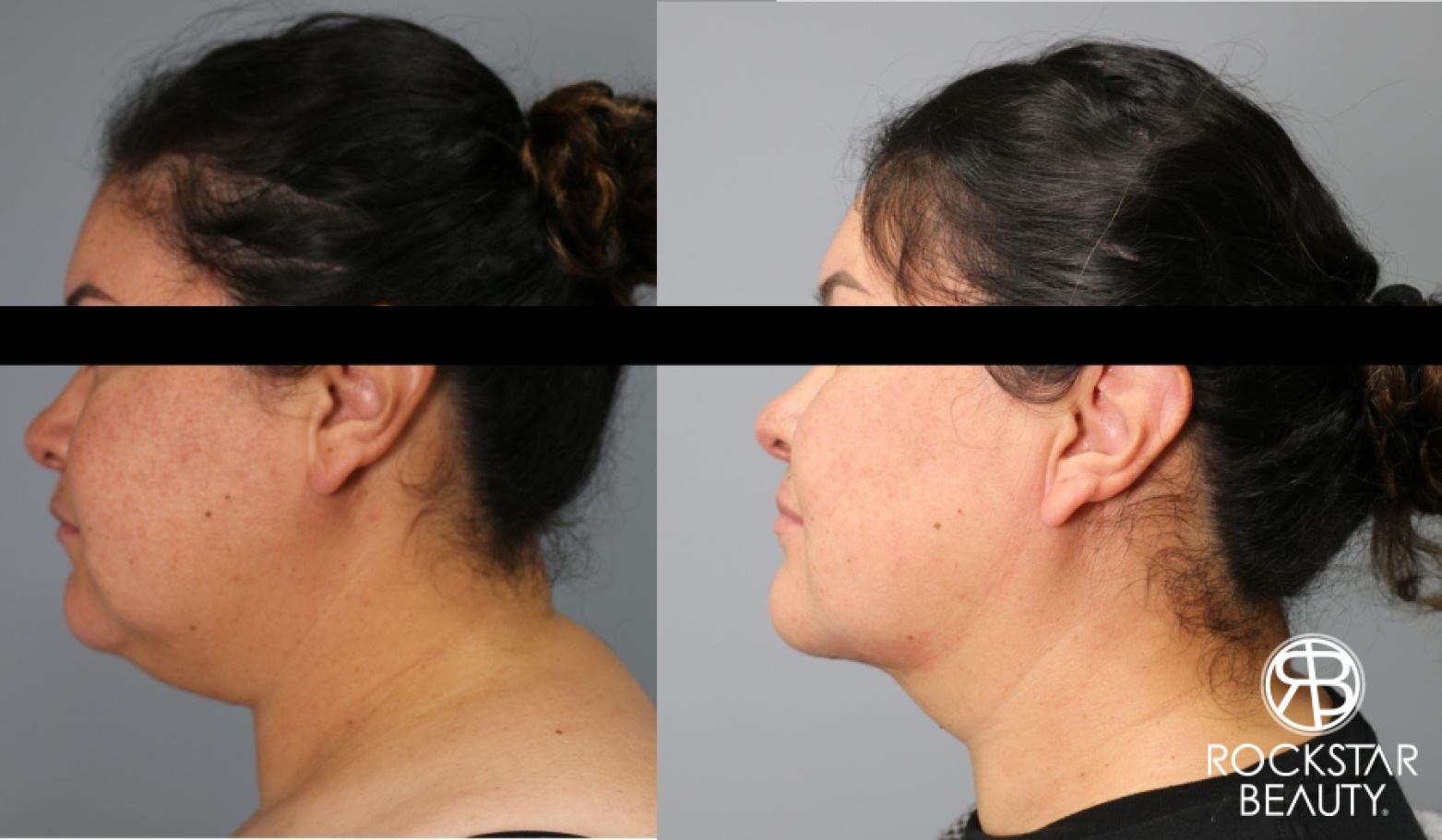 Liposuction Of The Neck: Patient 7 - Before and After  