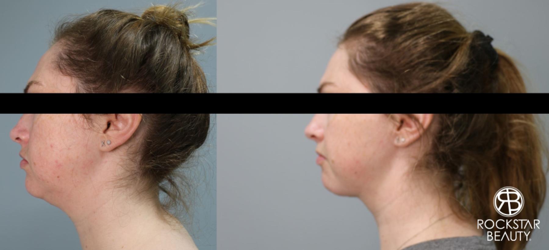 Liposuction Of The Neck: Patient 43 - Before and After 1