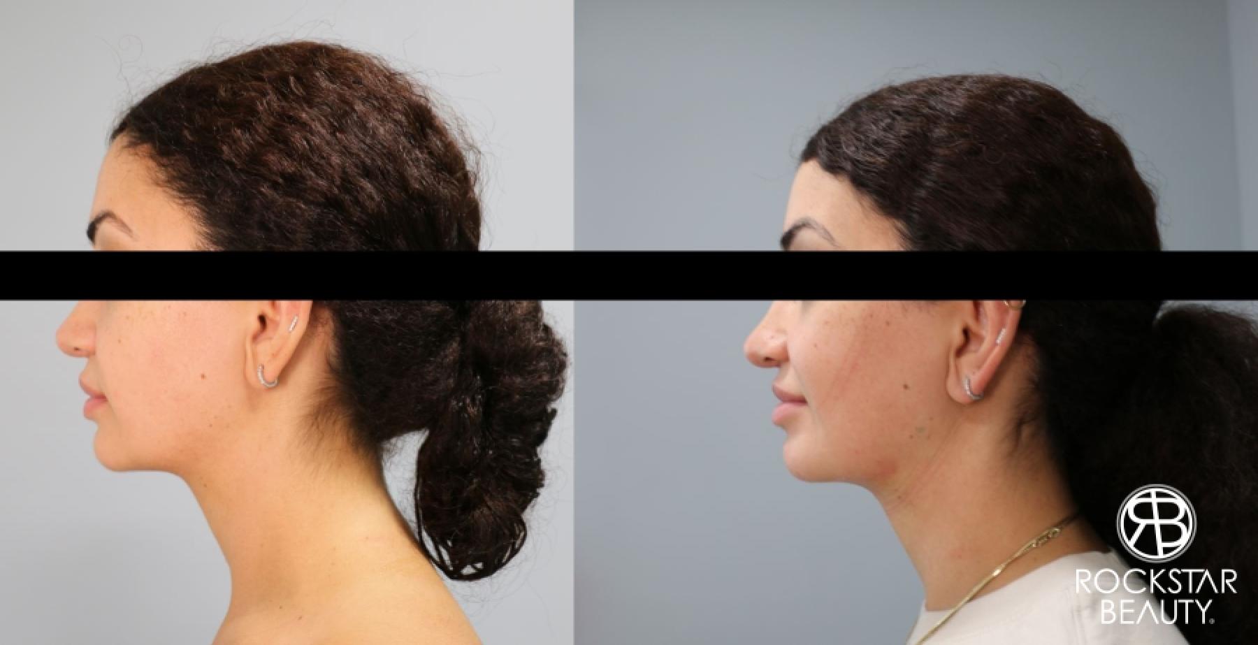 Liposuction Of The Neck: Patient 15 - Before and After 1