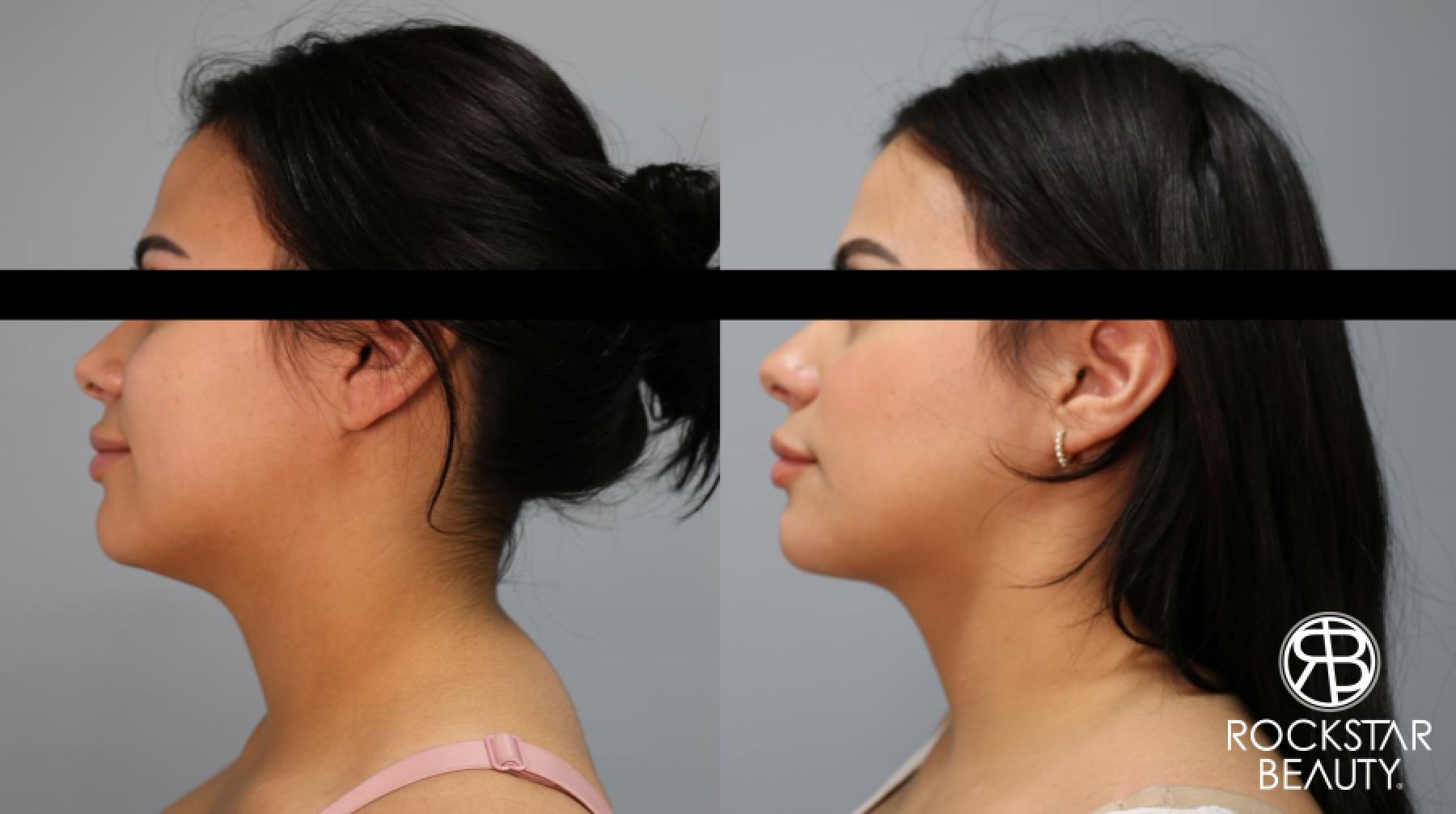 Liposuction Of The Neck: Patient 27 - Before and After 1