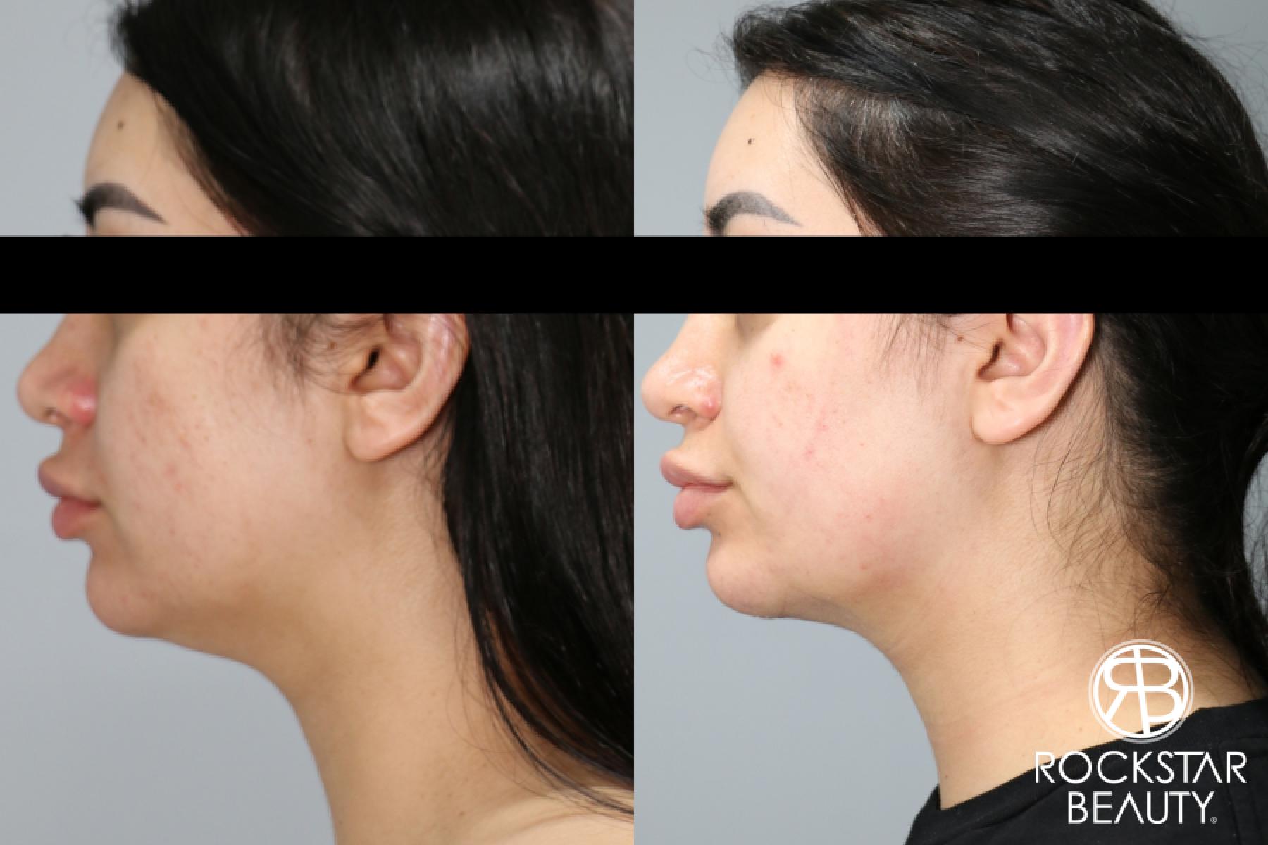 Liposuction Of The Neck: Patient 46 - Before and After 1