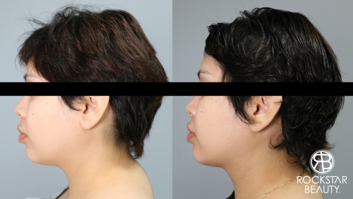 Liposuction Of The Neck: Patient 30 - Before and After 1