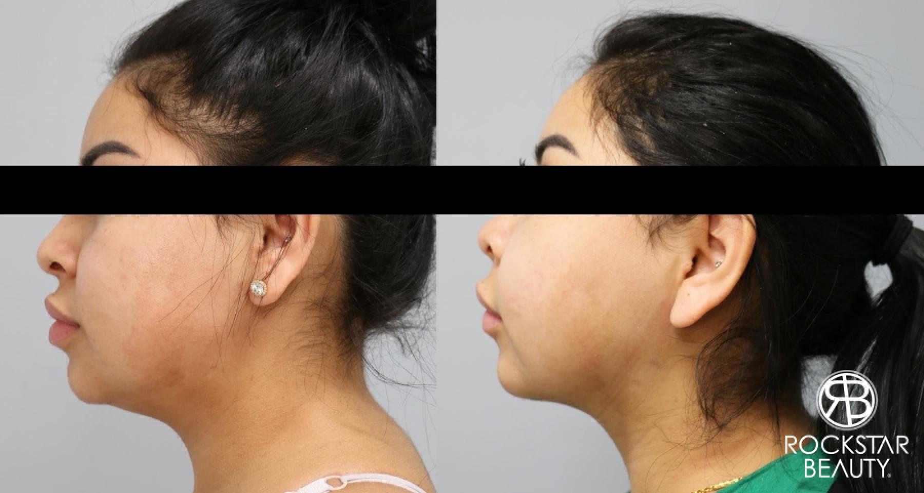 Liposuction Of The Neck: Patient 14 - Before and After 1