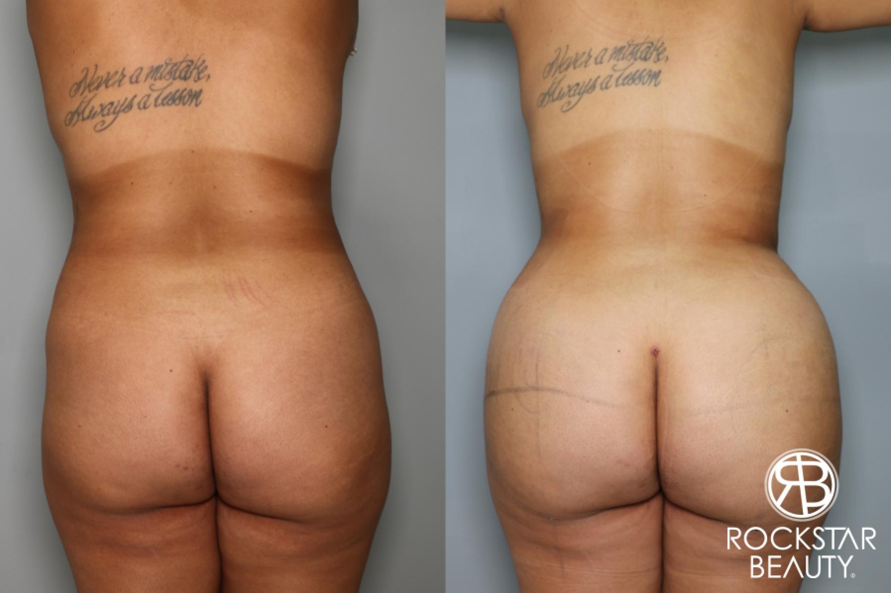 Brazilian Butt Lift: Patient 8 - Before and After  