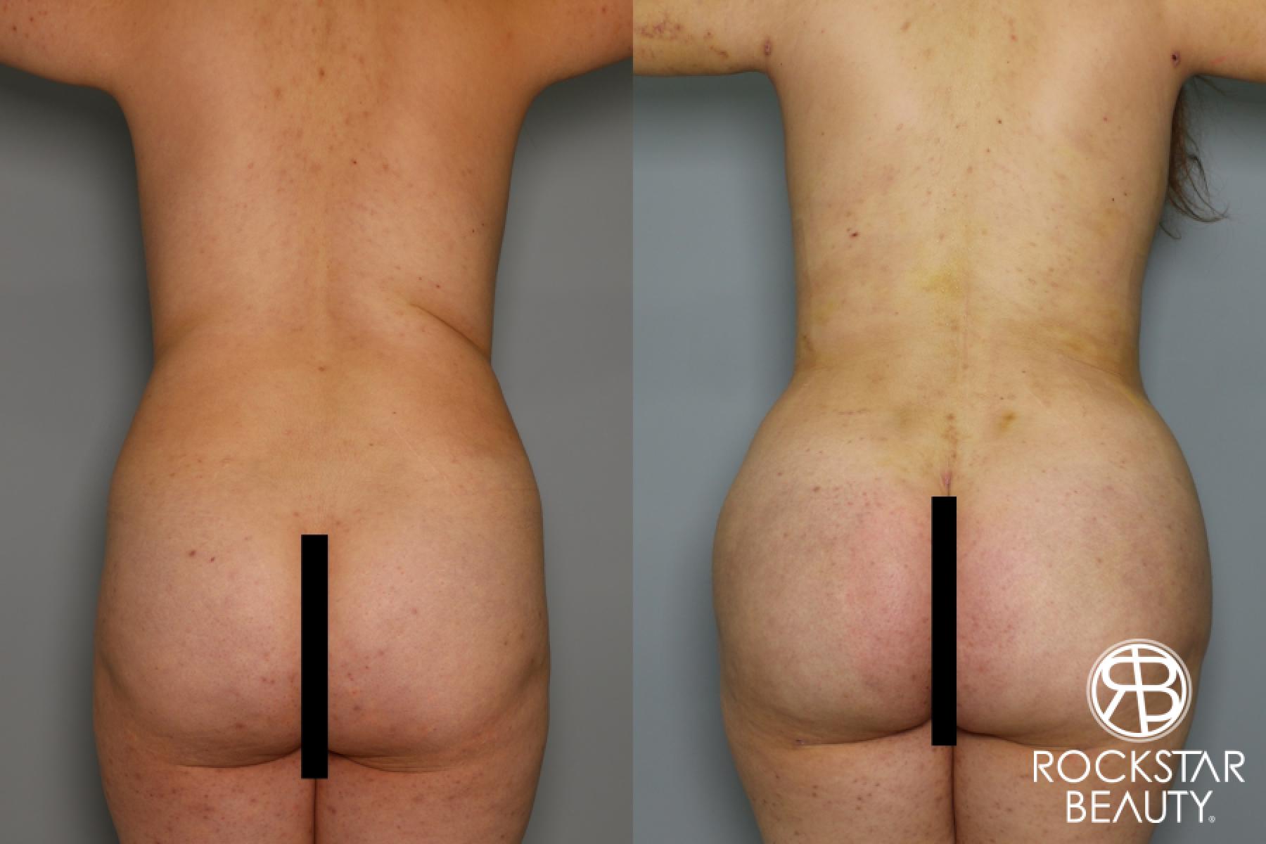 Brazilian Butt Lift: Patient 6 - Before and After  