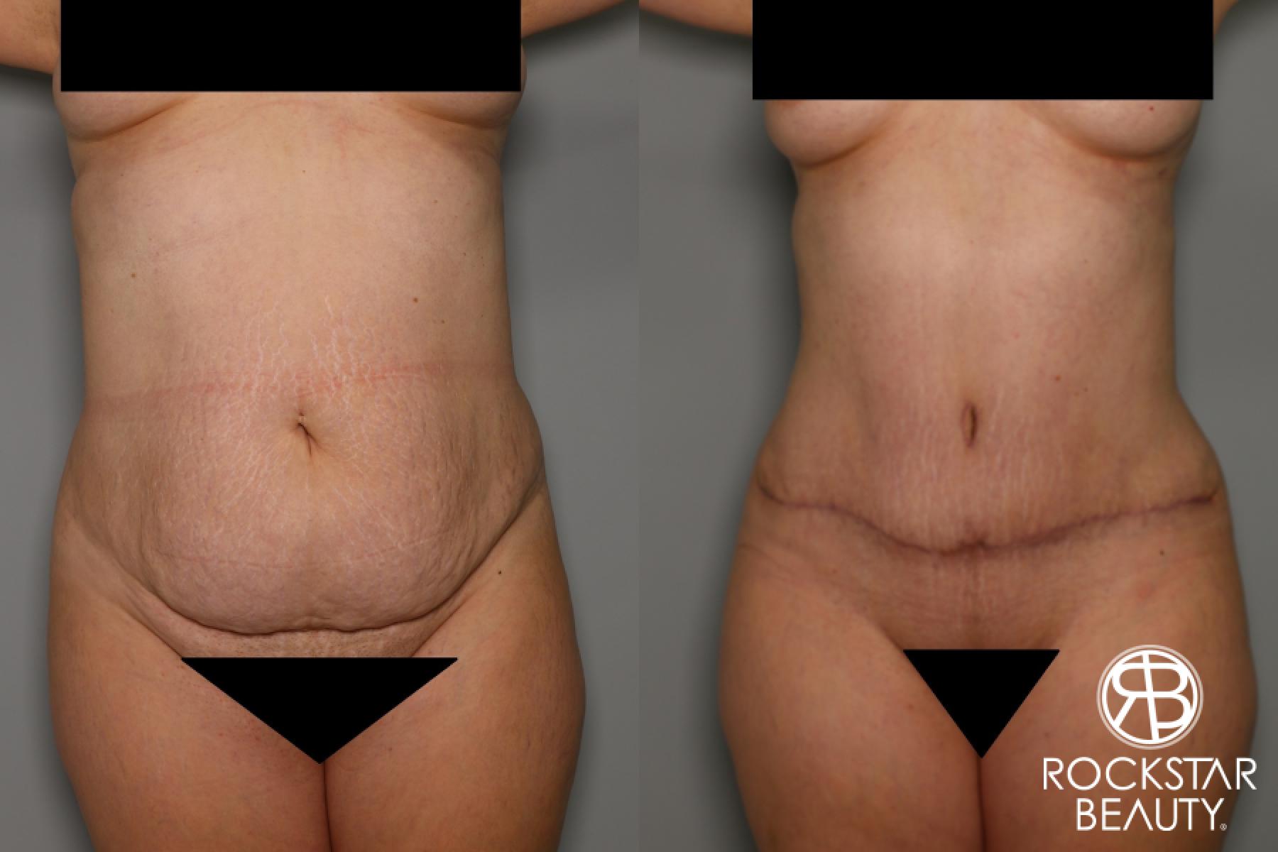 Tummy Tuck: Patient 5 - Before and After  