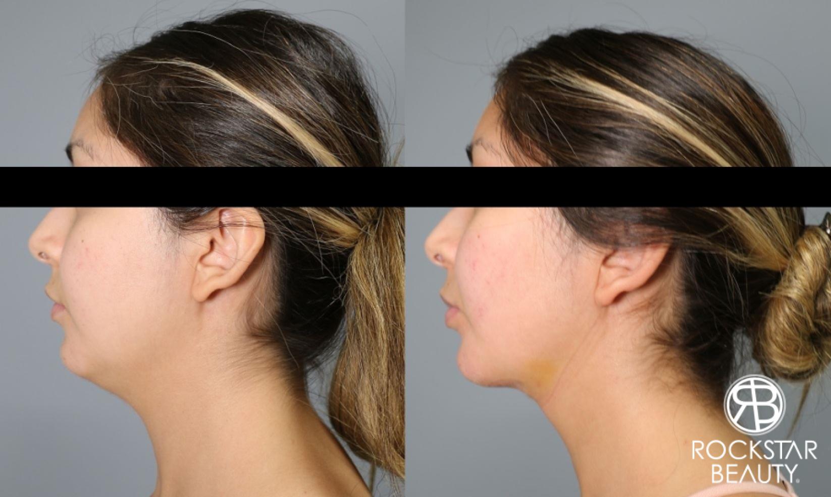 Liposuction Of The Neck: Patient 4 - Before and After  