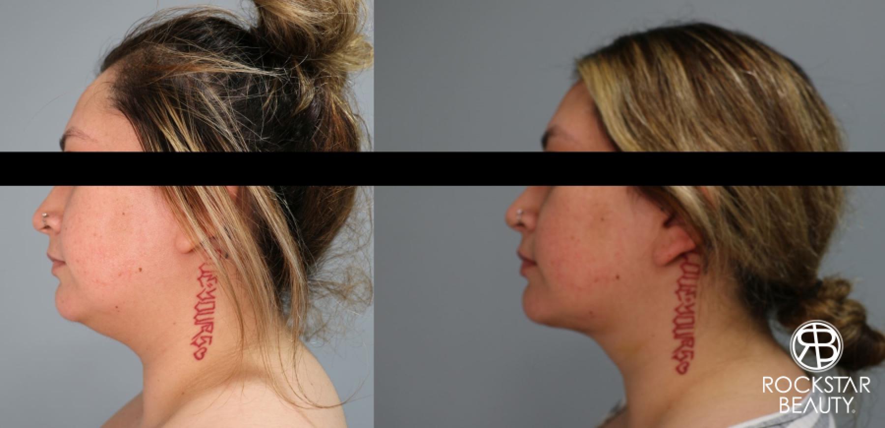 Liposuction Of The Neck: Patient 60 - Before and After 1