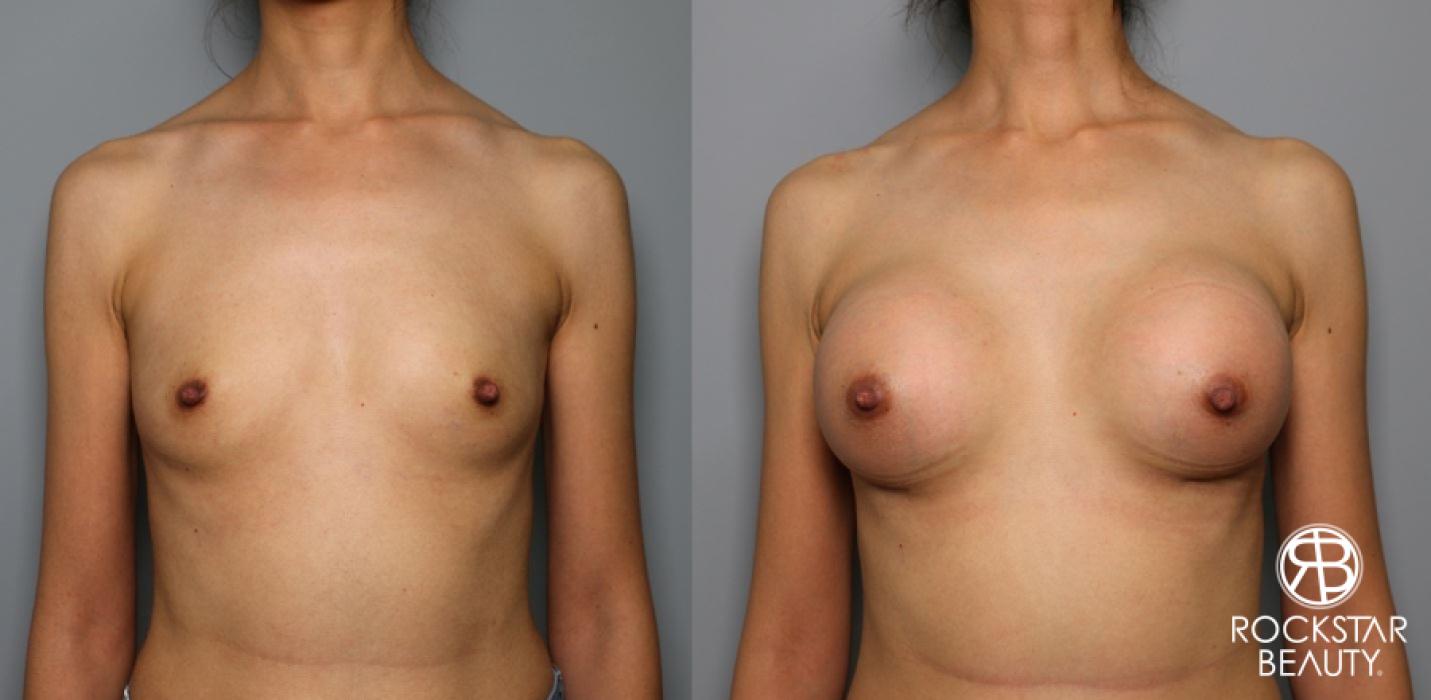 Breast Augmentation: Patient 30 - Before and After 1