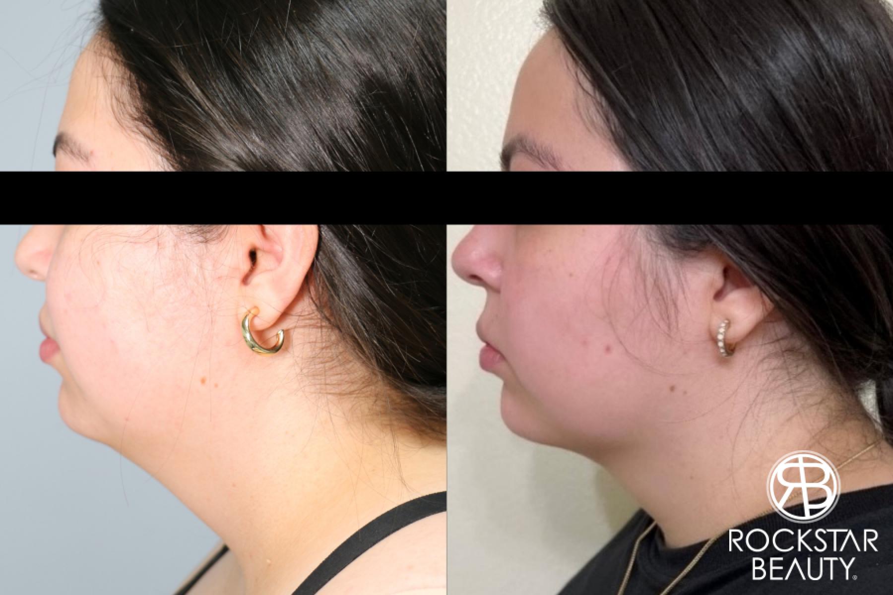 Liposuction Of The Neck: Patient 54 - Before and After 1