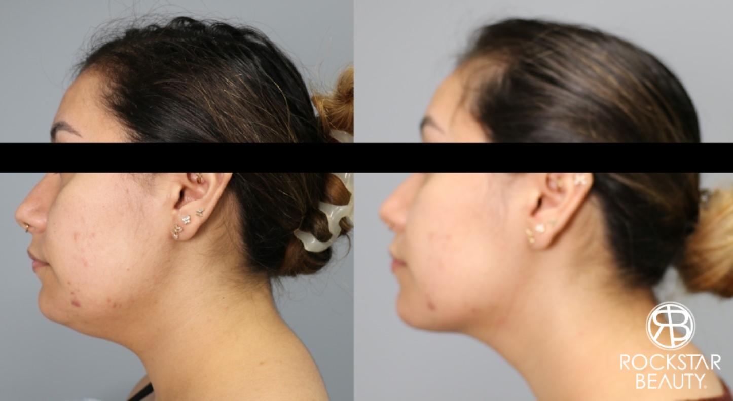 Liposuction Of The Neck: Patient 19 - Before and After 1